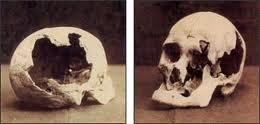 andrew and abigail borden's fractured skulls