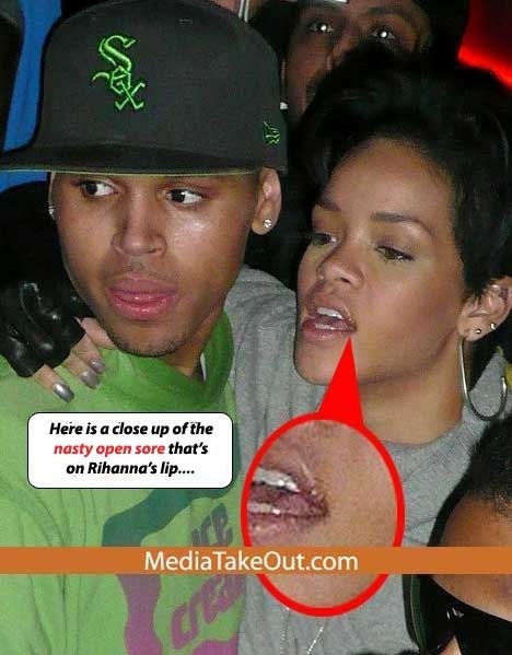 herpes pictures. RIHANNA HAS HERPES!