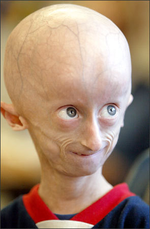 Daily Diseases and Disorders - PROGERIA