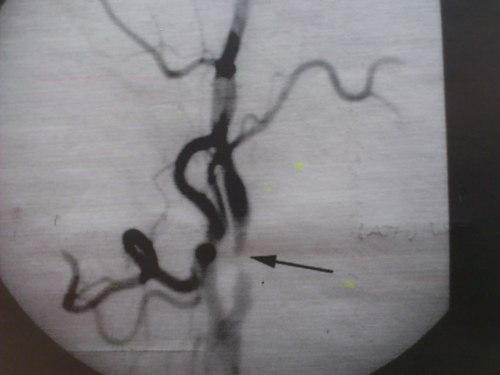angiografía anormal