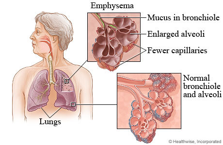 bronchitis lungs
