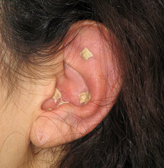 Ear Patch For Weight Loss
