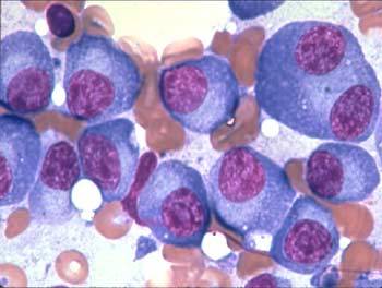 New combination therapy developed for multiple mYeloma