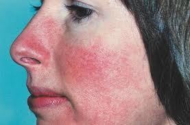 Red itchy rash on face