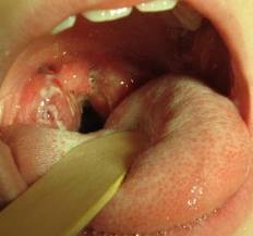 Viral vs bacterial throat infection