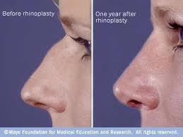 Asian nose rhinoplasty