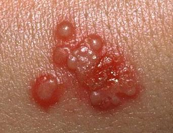 Early signs of herpes on penis