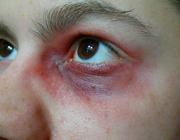 Bruised face tumblr
