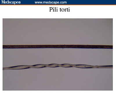 Pili torti | Genetic and Rare Diseases Information Center ...